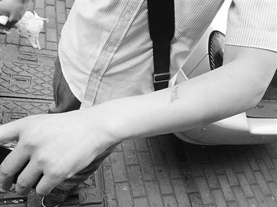 手臂出現(xiàn)肌肉拉傷情況需要如何處理