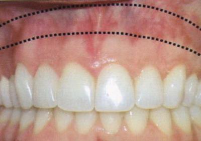 牙齦壞了的治療方法以及應(yīng)該如何修復(fù)牙齦