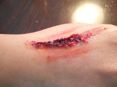 身體受傷用什么消炎對傷口效果最好 身體受傷用什么消炎對傷口效果最好