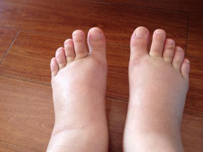 導致人在下午的時候會腳腫的原因