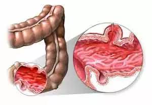 在懷孕期間出現腸胃炎要如何治療 在懷孕期間出現腸胃炎要如何治療