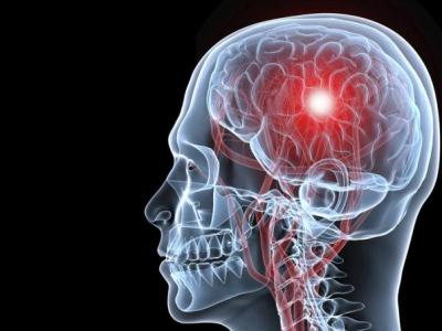 腦梗患者在病情的早期如何治療最好