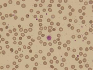 捐獻血小板會對身體產生哪些負面影響