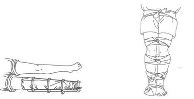 做一個小腿骨折的手術需要多長時間-易網健康<a href=http://www.xllyou.com/jkys/ target=_blank class=infotextkey>養生</a>網 做一個小腿骨折的手術需要多長時間