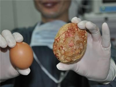 尿路結石是吃進的小石子?