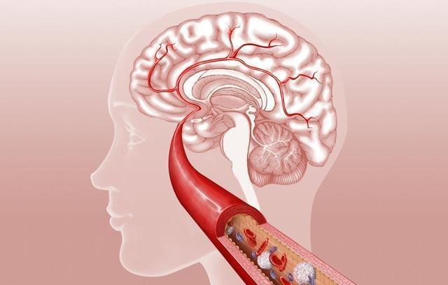 腦血栓患者吃哪些種類藥治療效果好-易網健康<a href=http://www.xllyou.com/jkys/ target=_blank class=infotextkey>養生</a>網 腦血栓患者吃哪些種類藥治療效果好