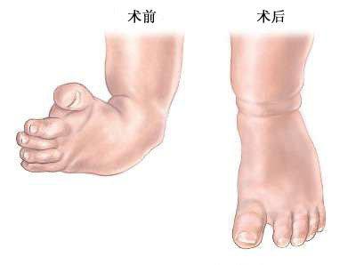 導致孩子足內翻的因素以及改善方法-易網健康<a href=http://www.xllyou.com/jkys/ target=_blank class=infotextkey>養生</a>網 導致孩子足內翻的因素以及改善方法