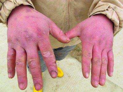 冬天天氣寒冷手部經常皴裂怎么辦