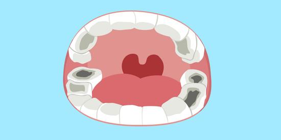 牙齒長了蛀牙自己要如何處理更好-易網健康<a href=http://www.xllyou.com/jkys/ target=_blank class=infotextkey>養生</a>網 牙齒長了蛀牙自己要如何處理更好