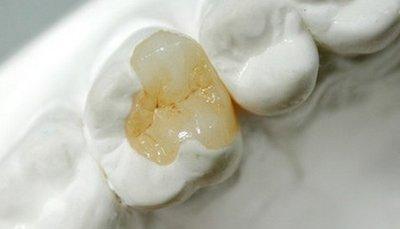 補(bǔ)完牙齒之后過多久可以開始吃東西