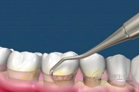洗牙有什么好處?洗牙后注意事項有哪些?-易網健康養生網 洗牙有什么好處?洗牙后注意事項有哪些?