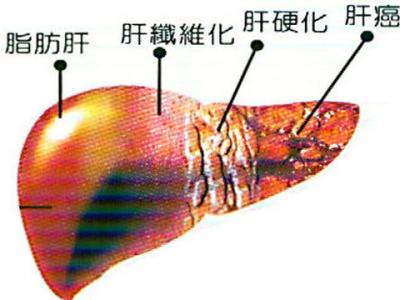 脂肪肝前期表現(xiàn)以及脂肪肝的預(yù)防方法