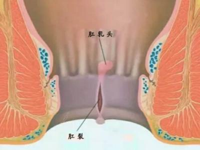 四種肛腸疾病即將出現的早期癥狀
