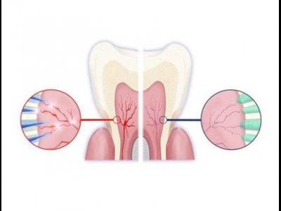 做好這六件事可以很好的預防牙齒敏感