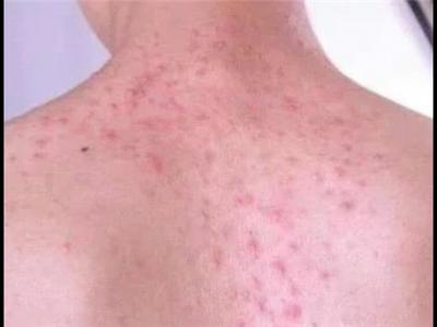 記住這四句話可以祛除體內的濕毒