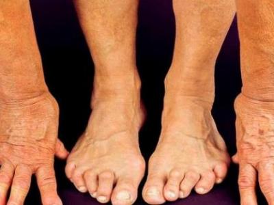 風濕有哪些治療方法風濕患者用什么好