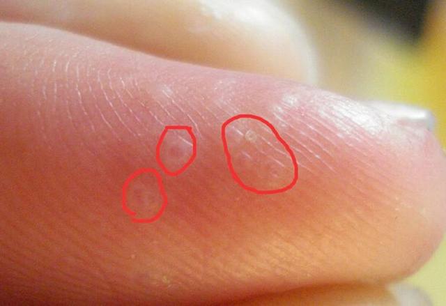 腳上的泡應該怎么處理腳上出泡怎么辦