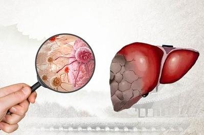 肝病有哪些病肝病具體分為哪些種類-易網(wǎng)健康<a href=http://www.xllyou.com/jkys/ target=_blank class=infotextkey>養(yǎng)生</a>網(wǎng) 肝病有哪些病肝病具體分為哪些種類