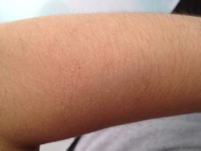 日光性皮炎患者可以正常參加軍訓嗎