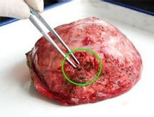 肝上有結(jié)節(jié)嚴重嗎肝結(jié)節(jié)一定是肝癌嗎-易網(wǎng)健康<a href=http://www.xllyou.com/jkys/ target=_blank class=infotextkey>養(yǎng)生</a>網(wǎng) 肝上有結(jié)節(jié)嚴重嗎肝結(jié)節(jié)一定是肝癌嗎