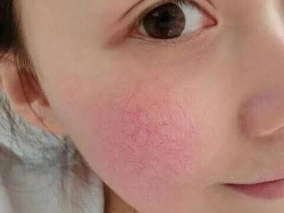 紅血絲形成的原因如何去除紅血絲
