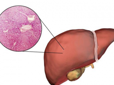 肝臟不好的人早晨起床會有這六個癥狀