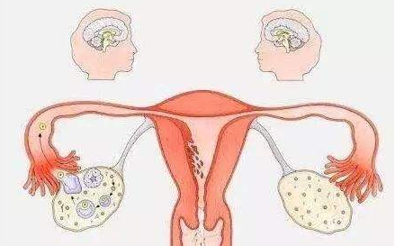 什么是多囊卵巢綜合癥如何預防多囊卵巢綜合癥