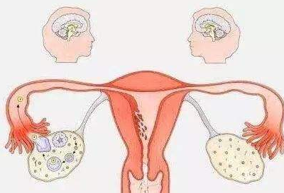 什么是多囊卵巢綜合癥如何預防多囊卵巢綜合癥