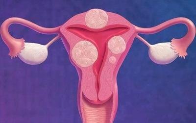 這七類女性是子宮肌瘤的高發(fā)人群-易網(wǎng)健康<a href=http://www.xllyou.com/jkys/ target=_blank class=infotextkey>養(yǎng)生</a>網(wǎng) 這七類女性是子宮肌瘤的高發(fā)人群