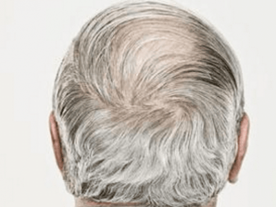 以下幾種方法有效幫你白頭發變黑