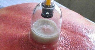 拔罐之后如果留下水泡應該如何處理