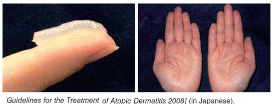 患特應性皮炎的人，如何“迎戰”秋燥？