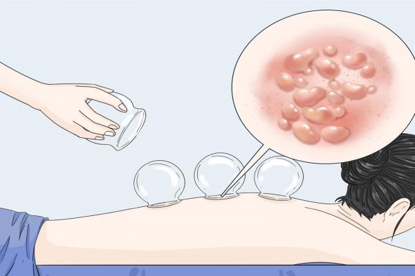 三伏天中午可以拔火罐嗎 三伏天拔罐的最佳時間-易網<a href=http://www.xllyou.com/ target=_blank class=infotextkey>健康養生</a>網 三伏天中午可以拔火罐嗎 三伏天拔罐的最佳時間