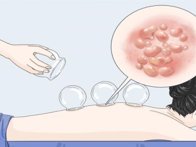 三伏天中午可以拔火罐嗎 三伏天拔罐的最佳時(shí)間