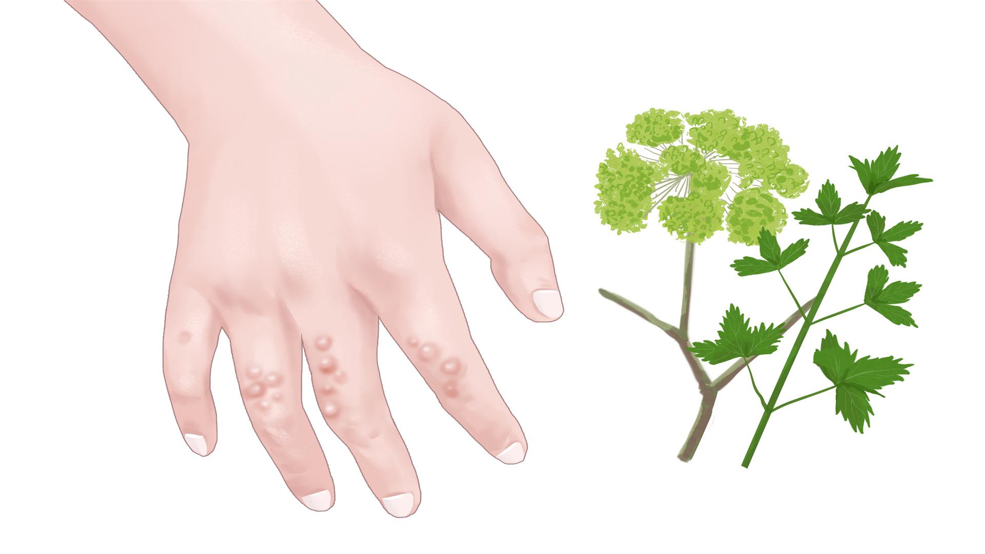 紅糖和山楂泡水喝能祛濕嗎 山楂的食用指南-易網健康<a href=http://www.xllyou.com/jkys/ target=_blank class=infotextkey>養生</a>網 紅糖和山楂泡水喝能祛濕嗎 山楂的食用指南