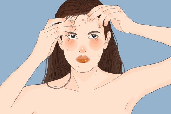 上火長痘痘怎么調(diào)理去火 上火冒痘吃什么降火