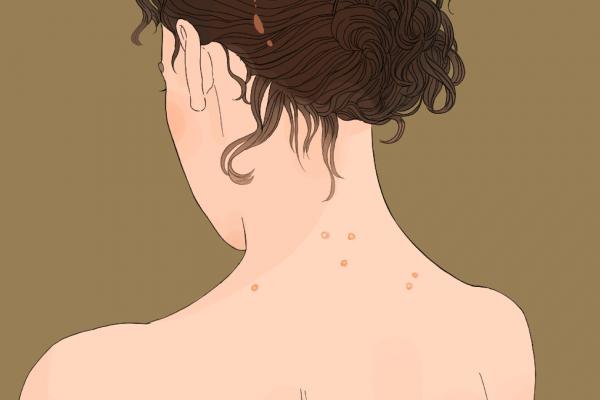 上火長痘痘怎么調(diào)理去火 上火冒痘吃什么降火