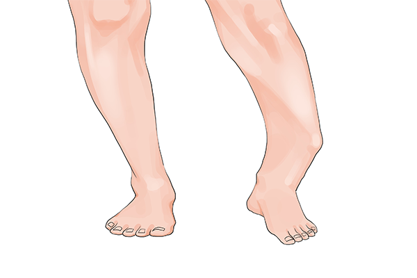 先天性馬蹄內翻足表現-易網健康<a href=http://www.xllyou.com/jkys/ target=_blank class=infotextkey>養生</a>網 先天性馬蹄內翻足表現