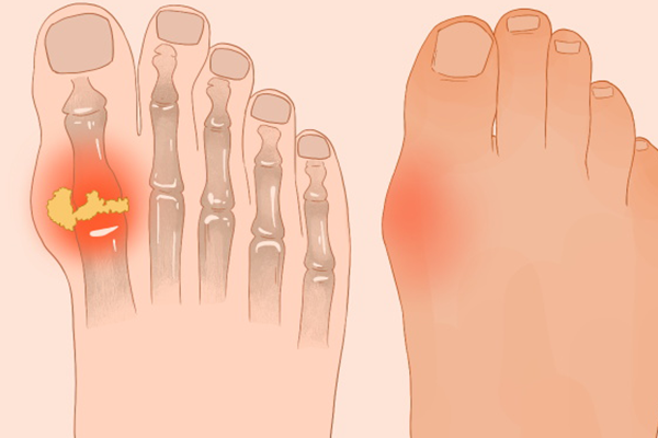 痛風能不能吃豬皮凍