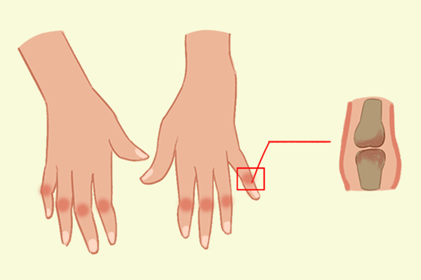 痛風(fēng)能不能吃辣條-易網(wǎng)<a href=http://www.xllyou.com/ target=_blank class=infotextkey>健康養(yǎng)生</a>網(wǎng) 痛風(fēng)能不能吃辣條