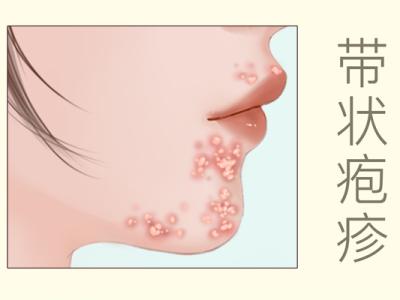 帶狀皰疹能吃羊肉嗎