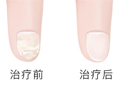 治療灰指甲哪家醫(yī)院好