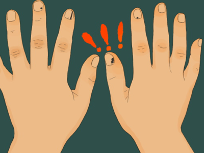 手上有朱砂痣是怎么回事