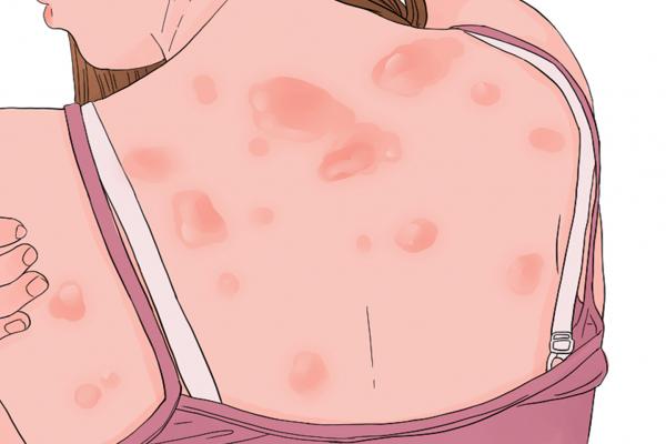 蕁麻疹能不能吃海苔-易網<a href=http://www.xllyou.com/ target=_blank class=infotextkey>健康養生</a>網 蕁麻疹能不能吃海苔