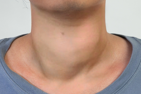 甲亢能吃羊肉嗎