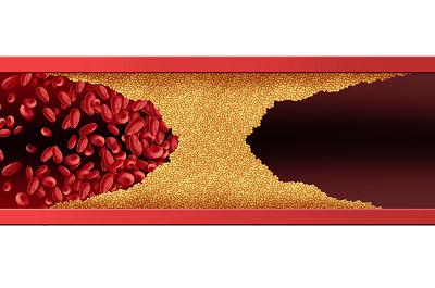 血管堵了自己有感覺(jué)嗎 血液病的三大預(yù)警信號(hào)