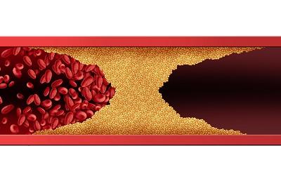 膽固醇高說白了就是缺蛋白質嗎 導致膽固醇高的三大原因