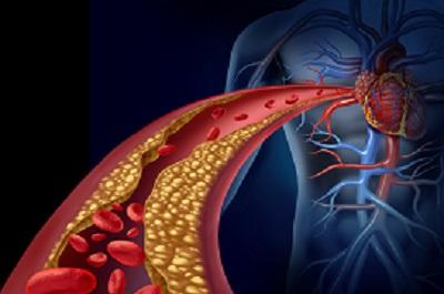 怎么知道自己血脂稠了 這些指標(biāo)異常證明血脂稠了