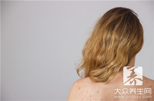 白駁風發(fā)病原因,你都知道嗎? 白駁風發(fā)病原因,你都知道嗎?