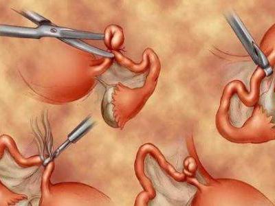 二胎剖腹產后做結扎手術 結扎對女性身體影響有多大
